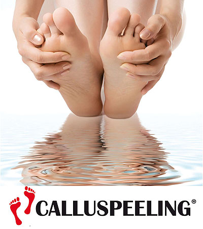 Calluspeeling